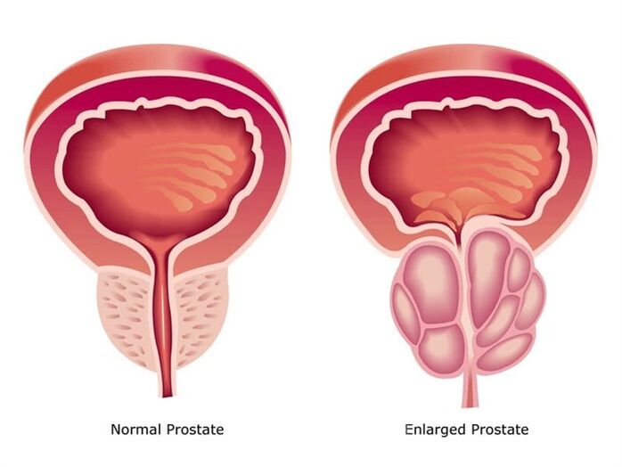 Prostovit normalizuje pracę i rozmiar prostaty