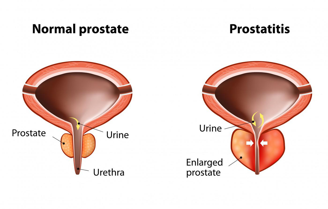 Normalna prostata zdrowego mężczyzny i zapalenie gruczołu krokowego z zapaleniem gruczołu krokowego