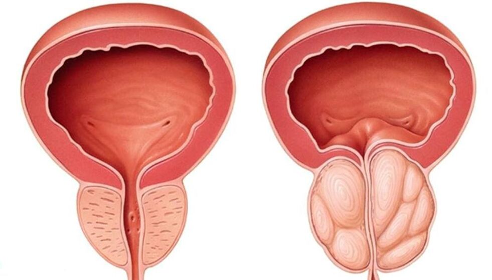 prostata normalna i powiększona