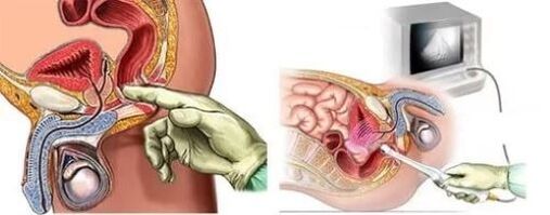 Instrumentalna diagnoza zapalenia prostaty